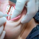 poner aparato dental