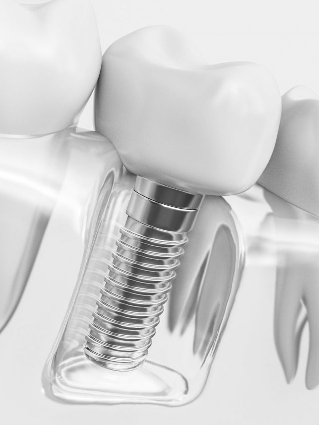 ¿Cómo se hace un implante dental?